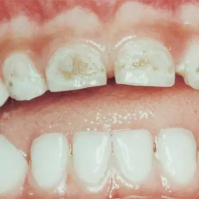 Baby teeth with brown spots visible on the teeth and gumline